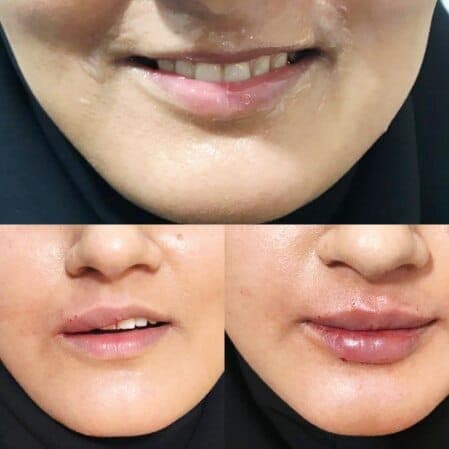 نمونه تزریق و زیبایی غیرجراحی صورت توسط دکتر نرگس مطلوبی، مورد ۱