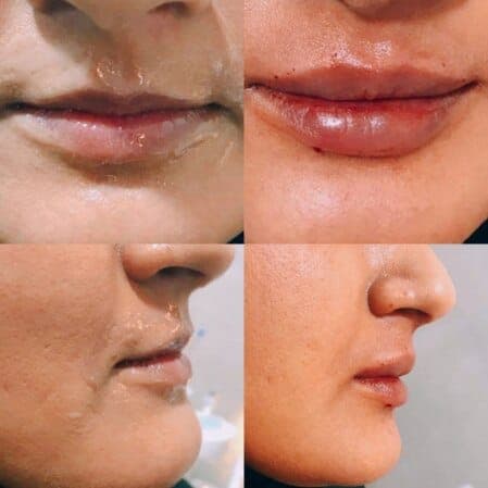 نمونه تزریق و زیبایی غیرجراحی صورت توسط دکتر نرگس مطلوبی، مورد ۳