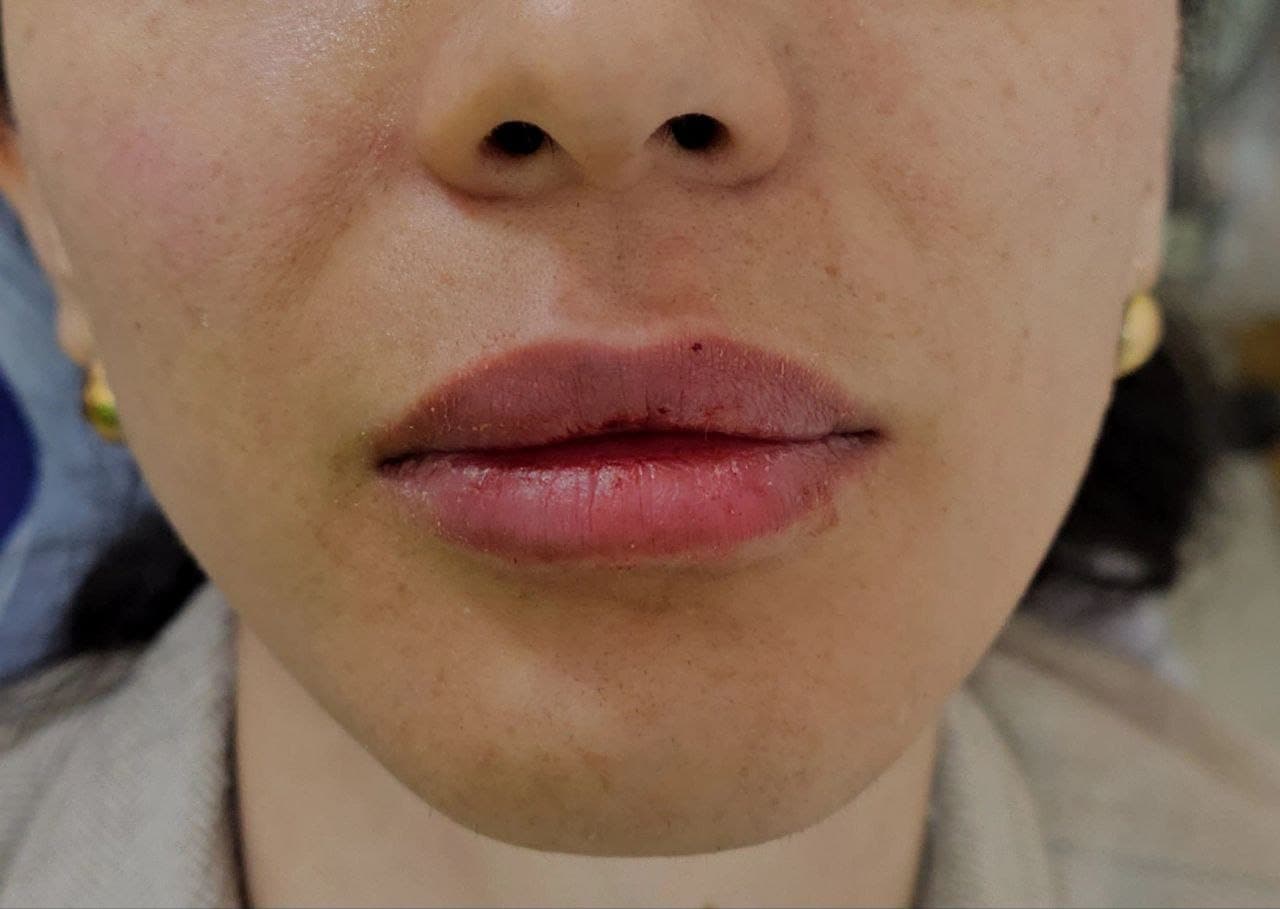 نمونه تزریق و زیبایی غیرجراحی صورت توسط دکتر نرگس مطلوبی، مورد ۸