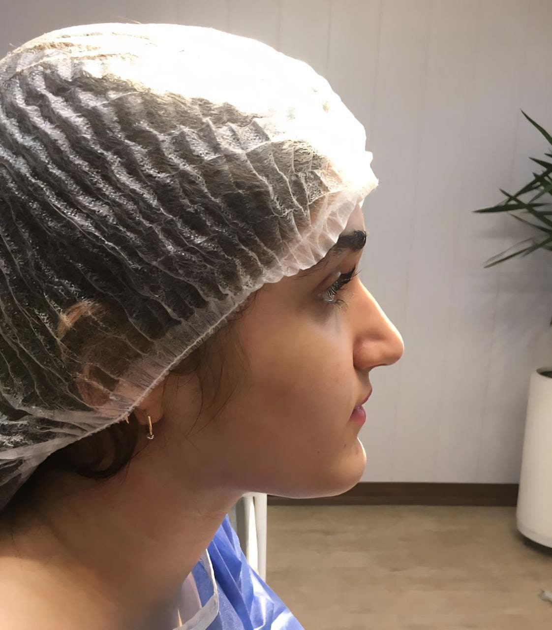 نمونه جراحی بینی و زیبایی صورت توسط دکتر نرگس مطلوبی، مورد ۴۳