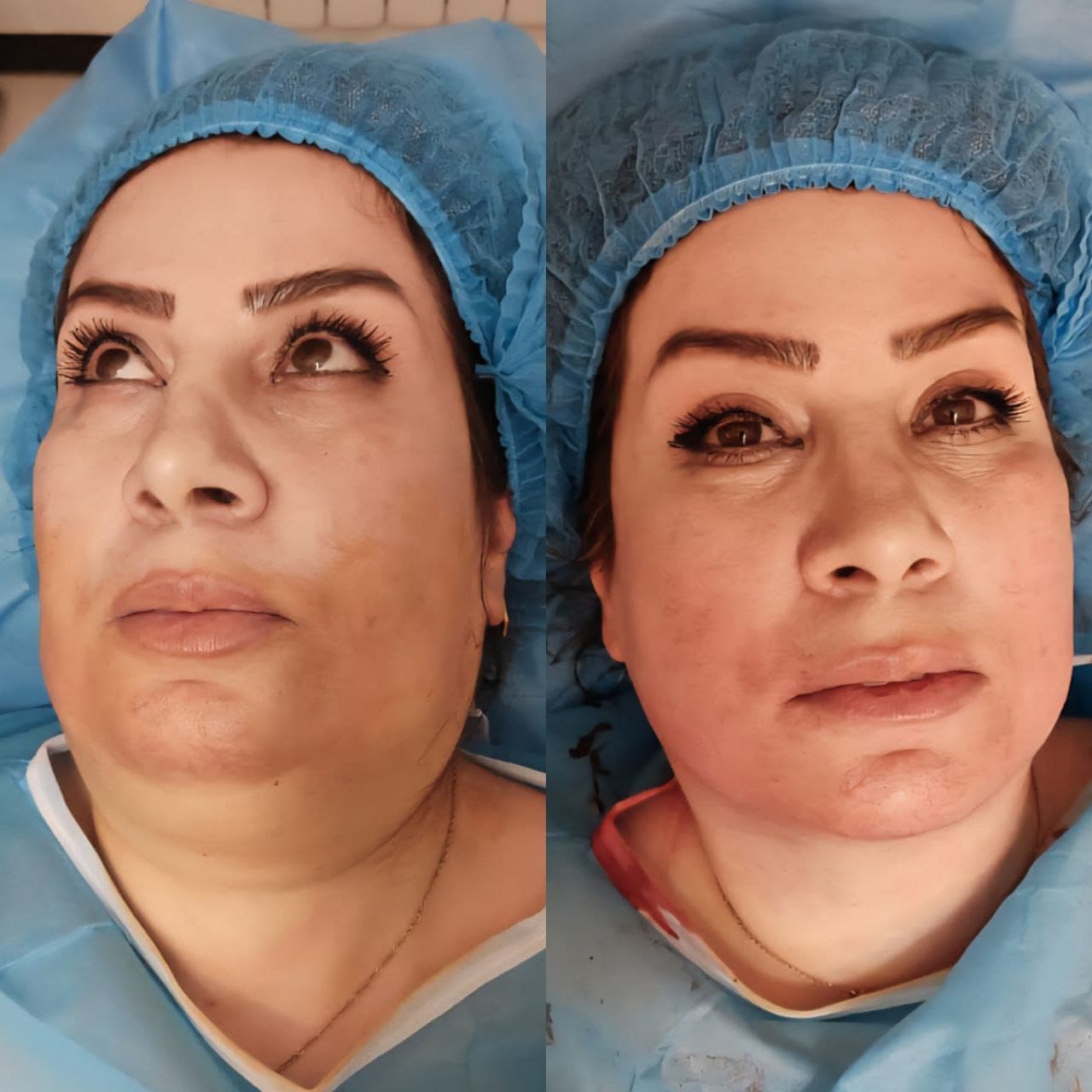 نمونه جراحی بینی و زیبایی صورت توسط دکتر نرگس مطلوبی، مورد ۴۹