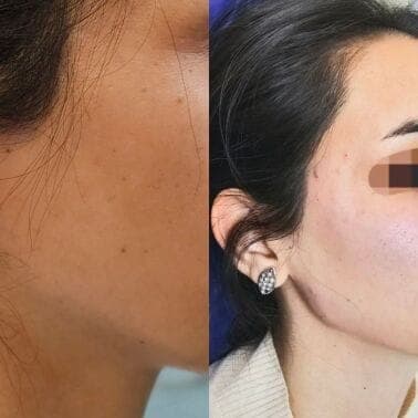 نمونه جراحی بینی و زیبایی صورت توسط دکتر نرگس مطلوبی، مورد ۵۶