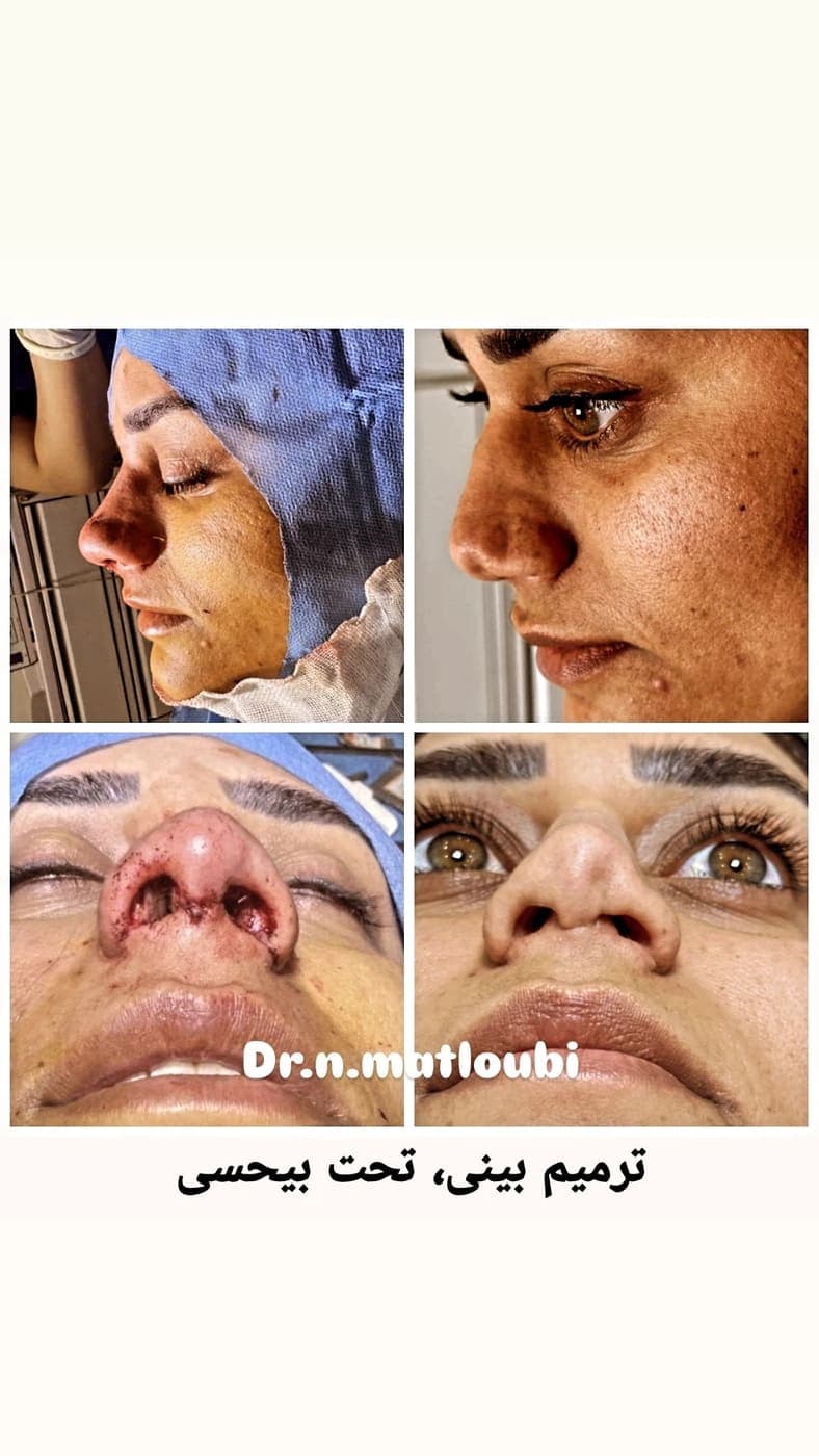 نمونه جراحی بینی و زیبایی صورت توسط دکتر نرگس مطلوبی، مورد ۱