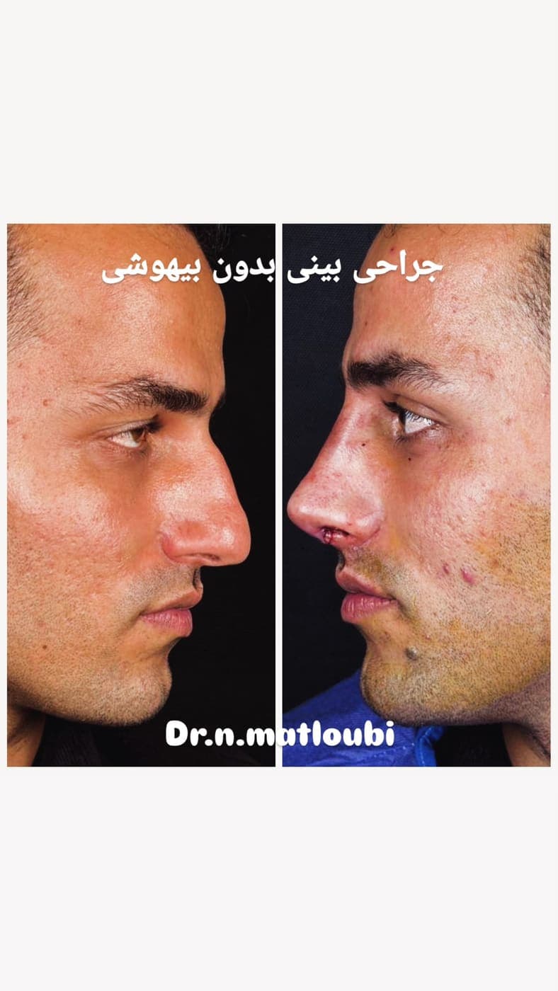 نمونه جراحی بینی و زیبایی صورت توسط دکتر نرگس مطلوبی، مورد ۲