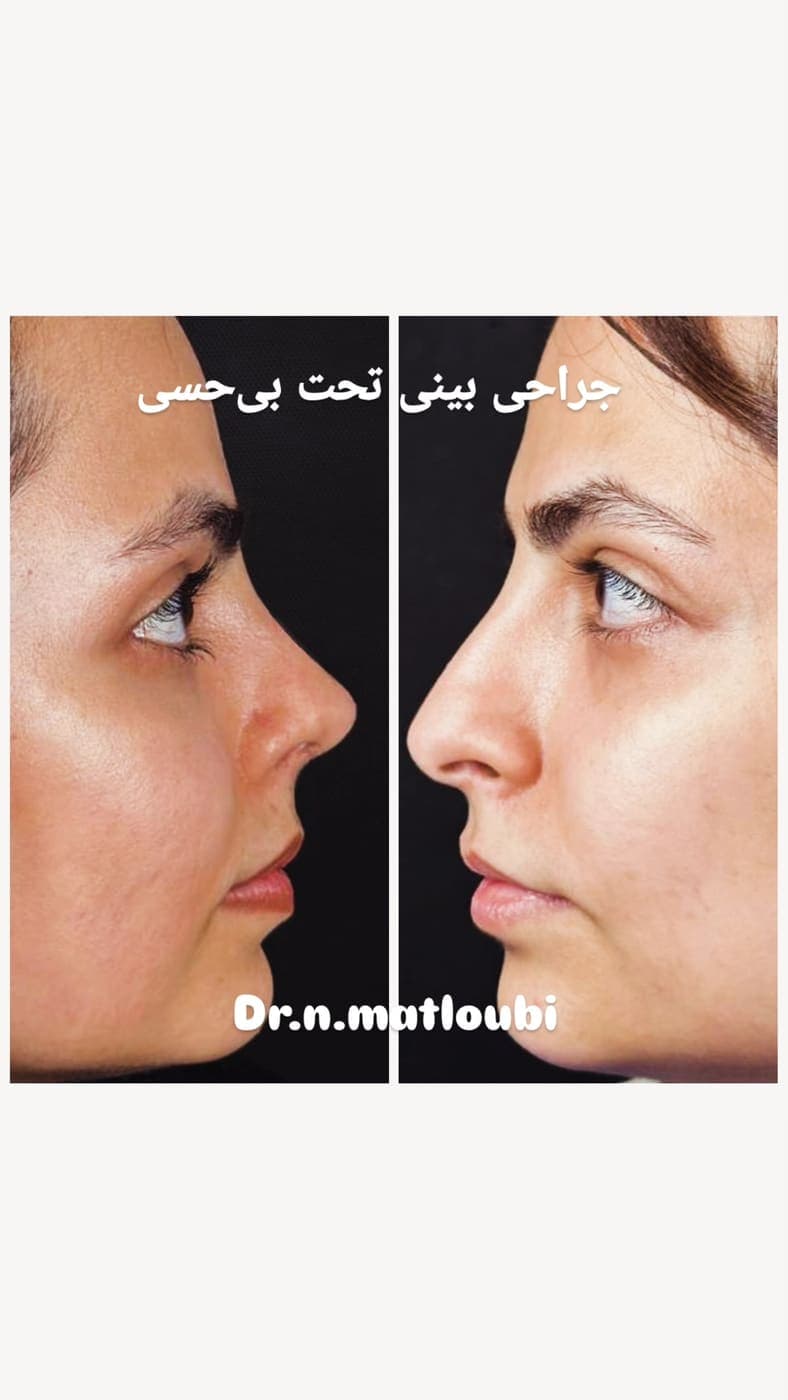 نمونه جراحی بینی و زیبایی صورت توسط دکتر نرگس مطلوبی، مورد ۳