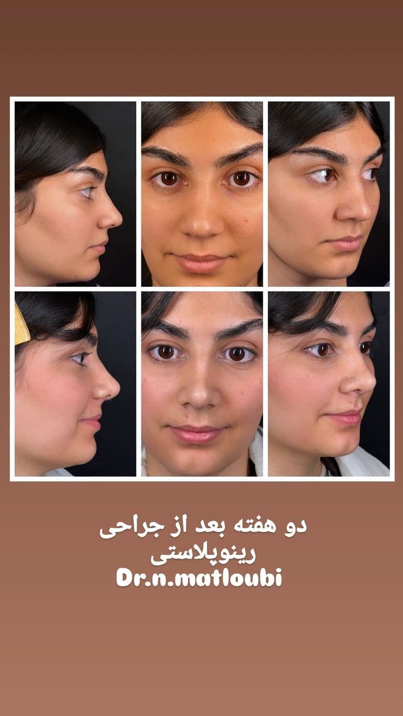 نمونه جراحی بینی و زیبایی صورت توسط دکتر نرگس مطلوبی، مورد ۴