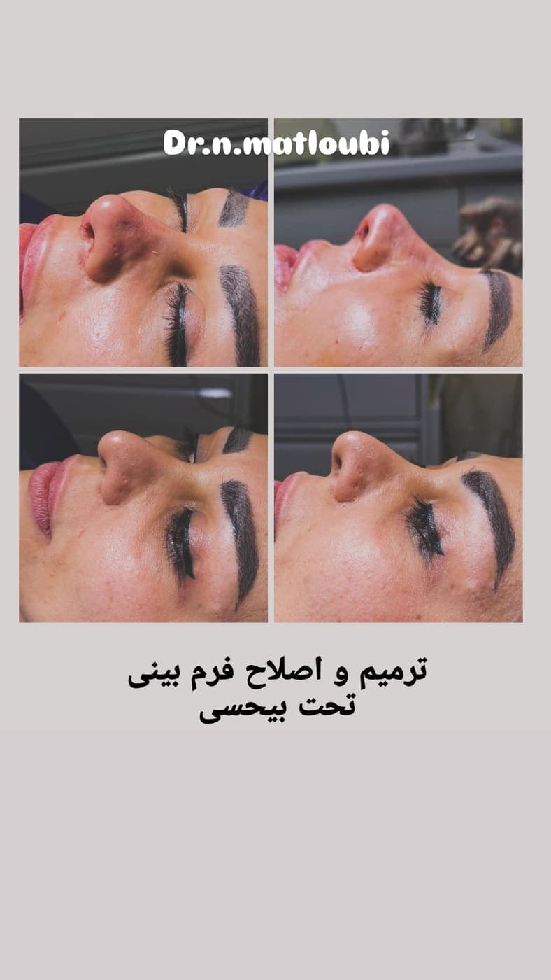 نمونه جراحی بینی و زیبایی صورت توسط دکتر نرگس مطلوبی، مورد ۵