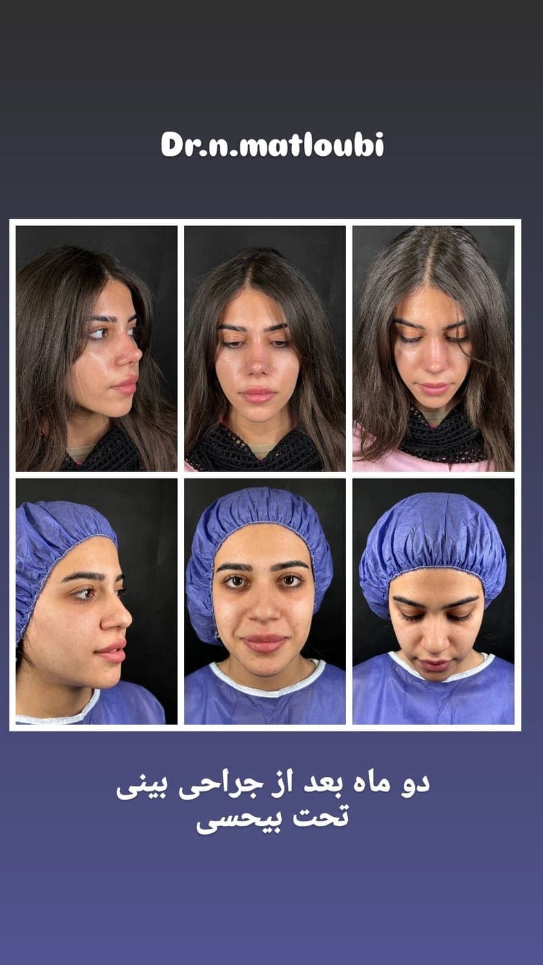 نمونه جراحی بینی و زیبایی صورت توسط دکتر نرگس مطلوبی، مورد ۶