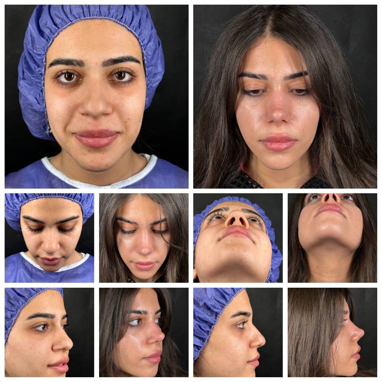 نمونه جراحی بینی و زیبایی صورت توسط دکتر نرگس مطلوبی، مورد ۷