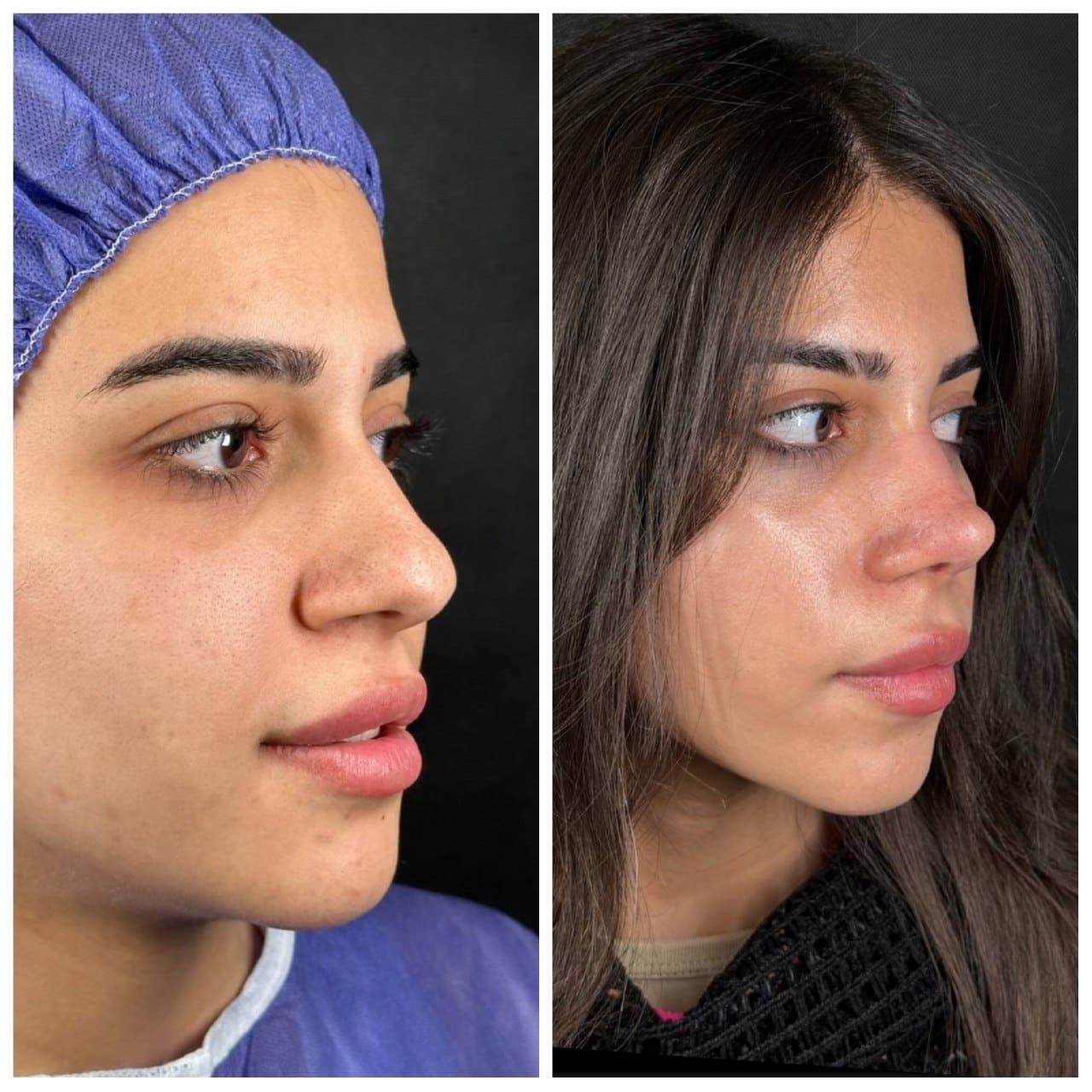 نمونه جراحی بینی و زیبایی صورت توسط دکتر نرگس مطلوبی، مورد ۹