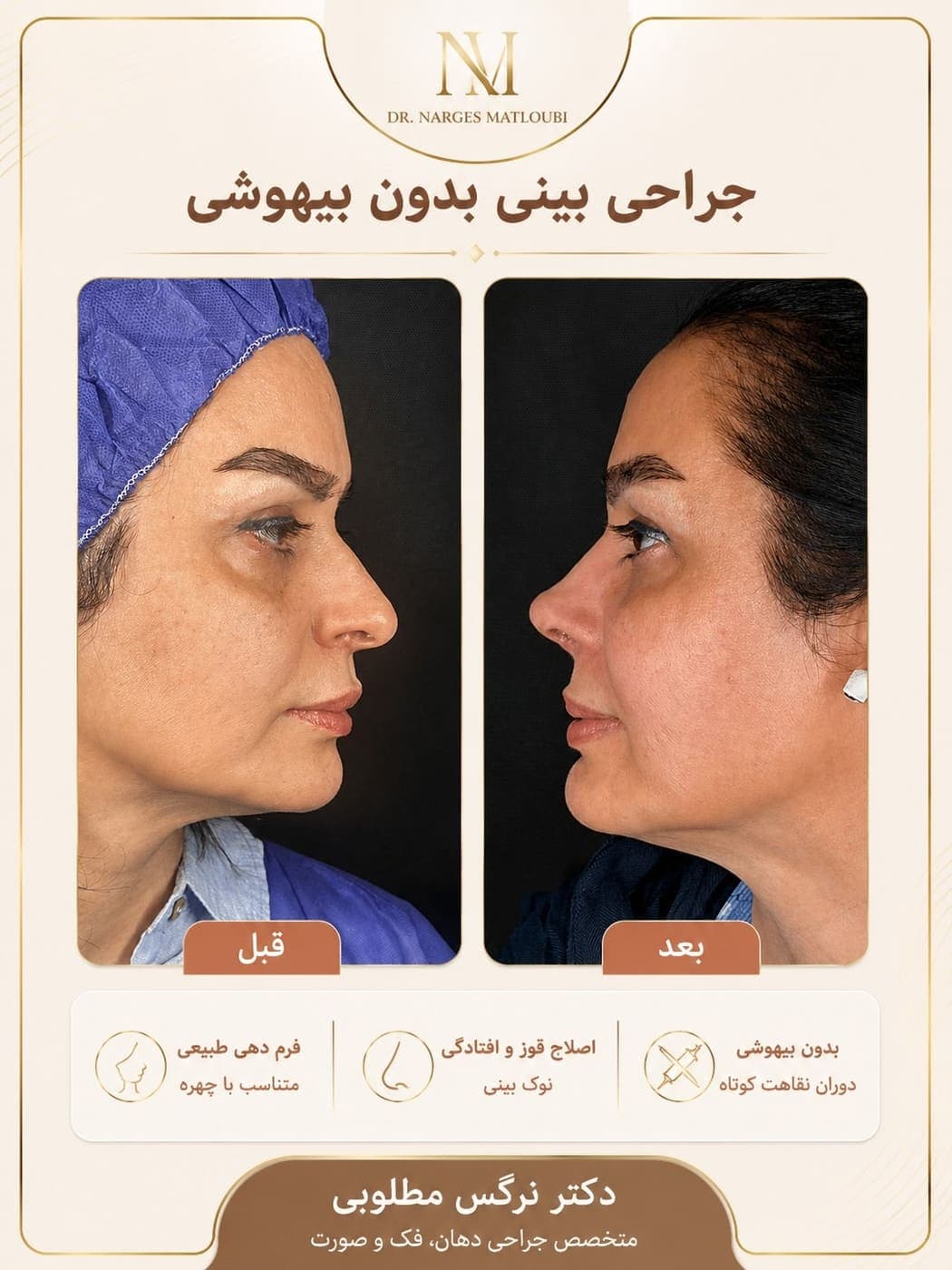 نمونه جراحی بینی و زیبایی صورت توسط دکتر نرگس مطلوبی، مورد ۱۰