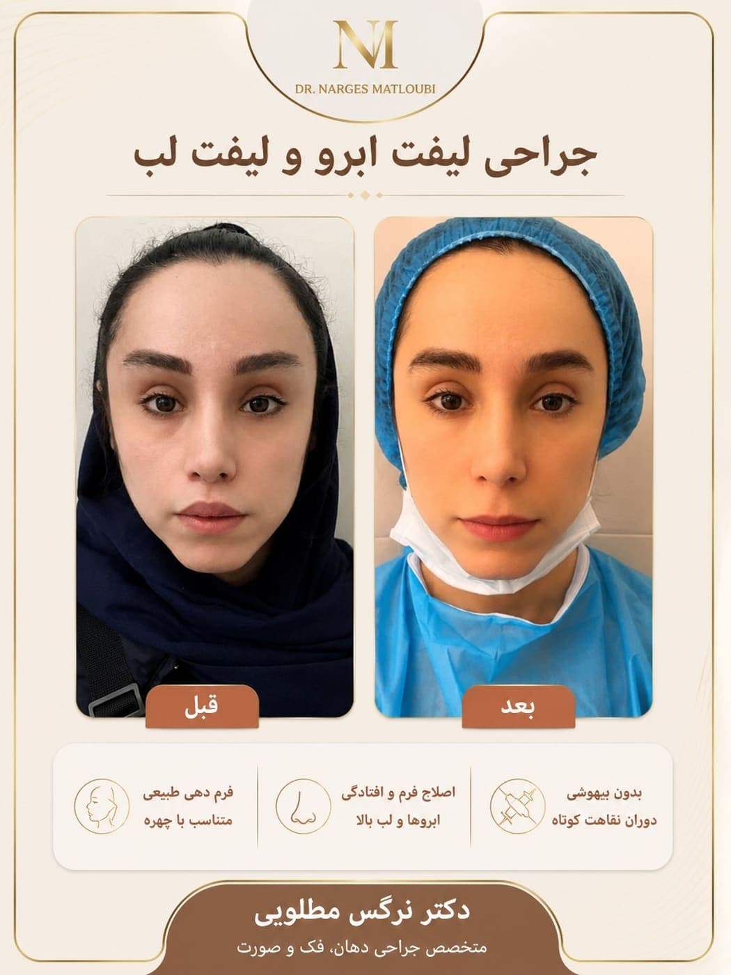 نمونه جراحی بینی و زیبایی صورت توسط دکتر نرگس مطلوبی، مورد ۱۱