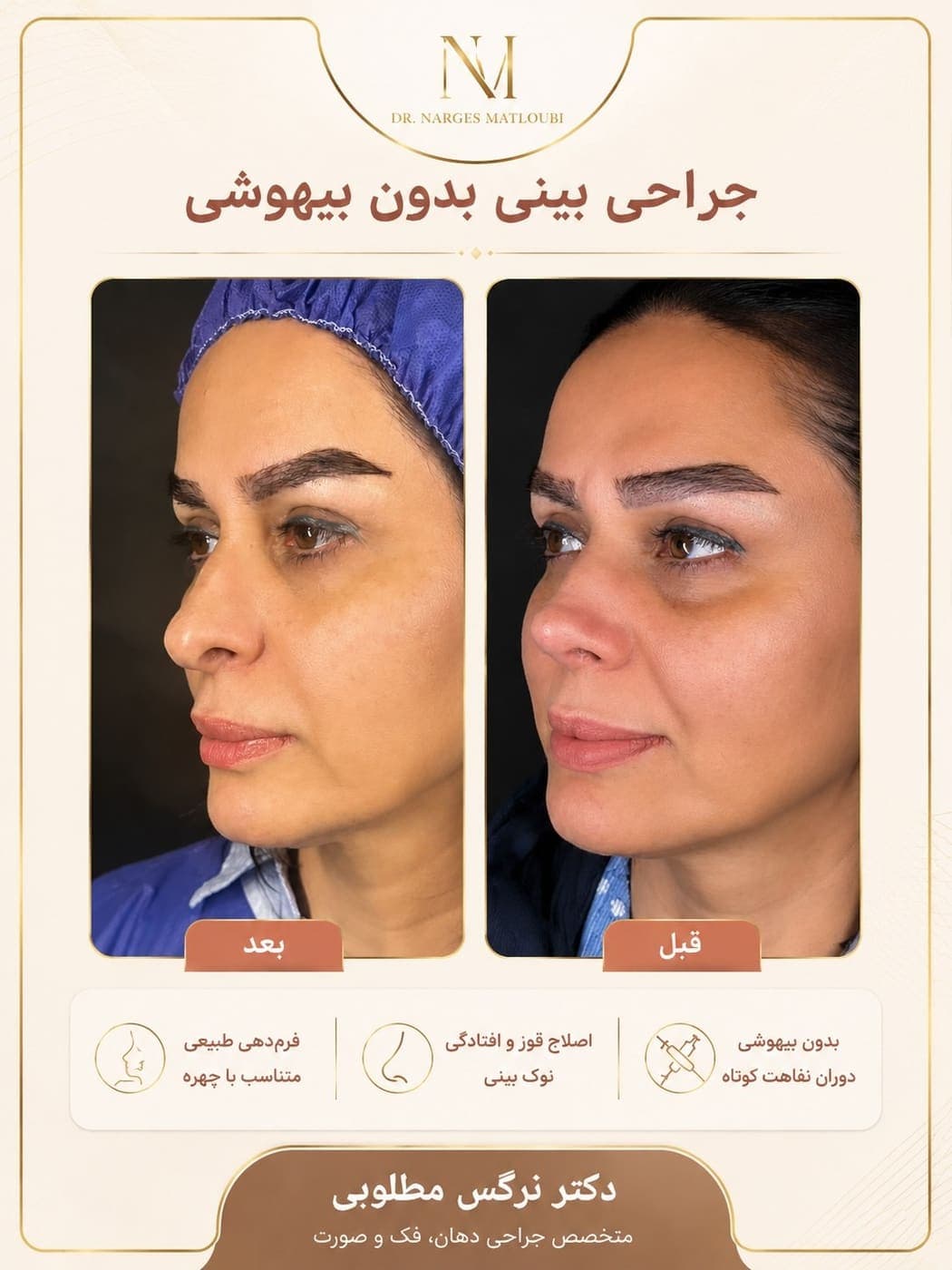 نمونه جراحی بینی و زیبایی صورت توسط دکتر نرگس مطلوبی، مورد ۱۲
