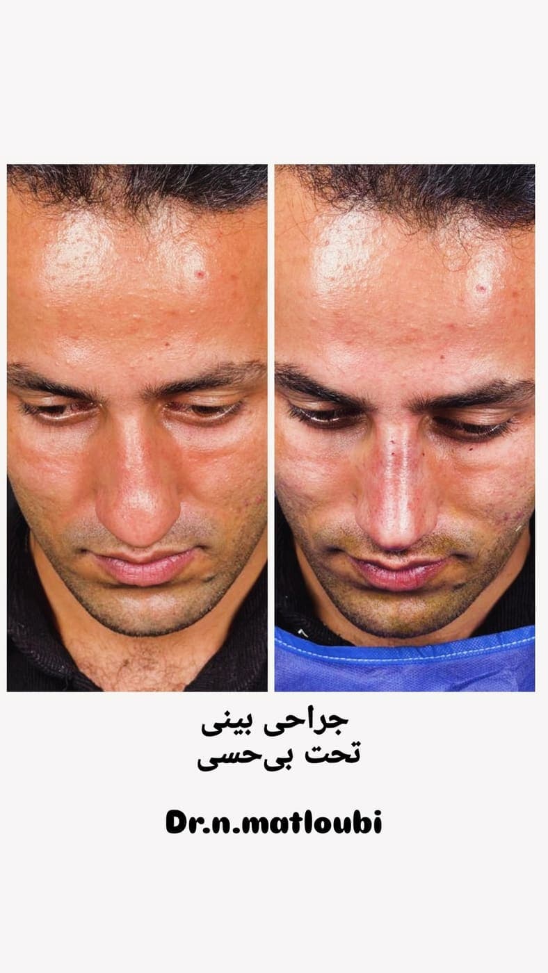 نمونه جراحی بینی و زیبایی صورت توسط دکتر نرگس مطلوبی، مورد ۱۵