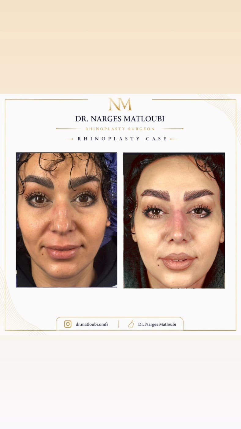 نمونه جراحی بینی و زیبایی صورت توسط دکتر نرگس مطلوبی، مورد ۱۹