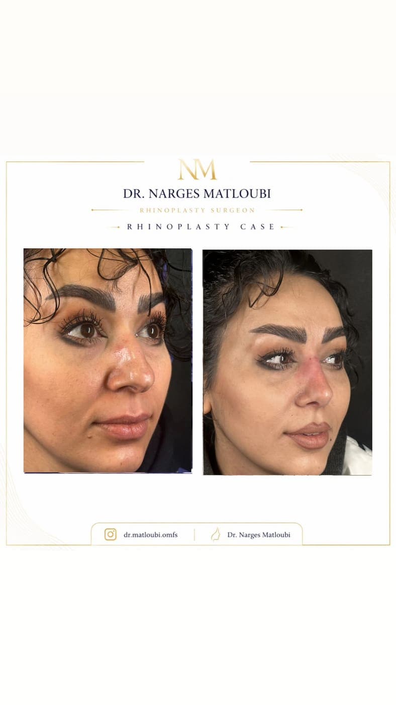 نمونه جراحی بینی و زیبایی صورت توسط دکتر نرگس مطلوبی، مورد ۲۱
