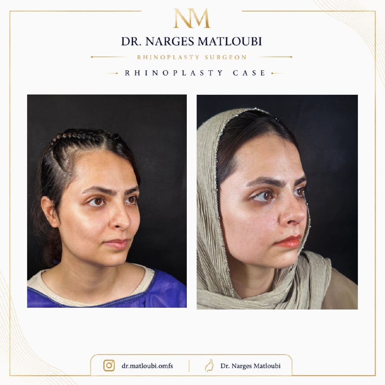 نمونه جراحی بینی و زیبایی صورت توسط دکتر نرگس مطلوبی، مورد ۲۲