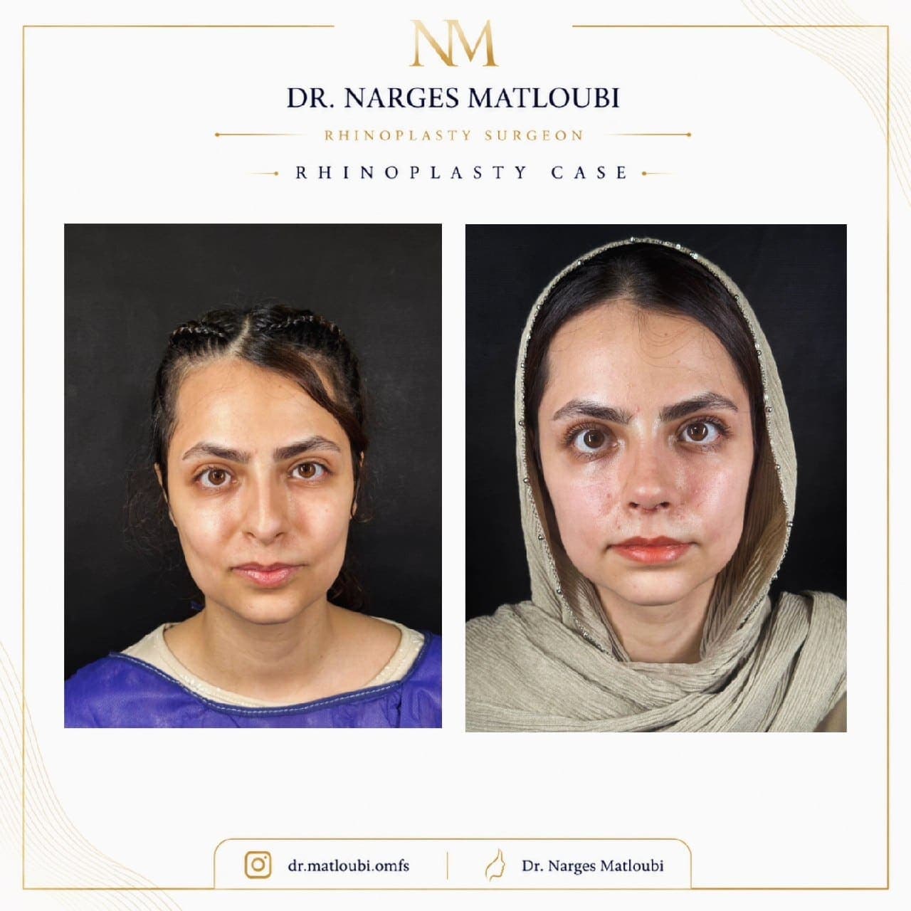 نمونه جراحی بینی و زیبایی صورت توسط دکتر نرگس مطلوبی، مورد ۲۳