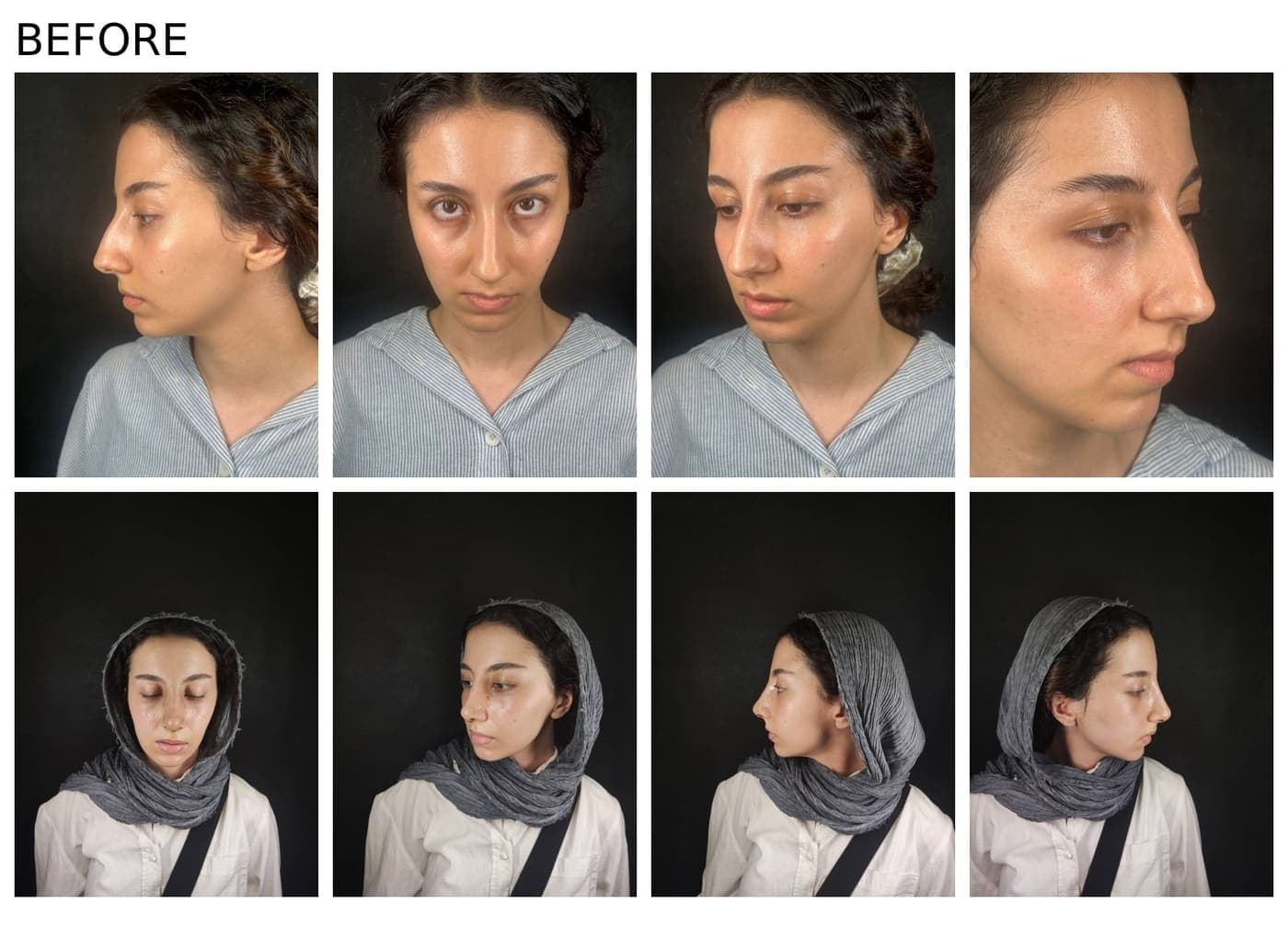 نمونه جراحی بینی و زیبایی صورت توسط دکتر نرگس مطلوبی، مورد ۲۵