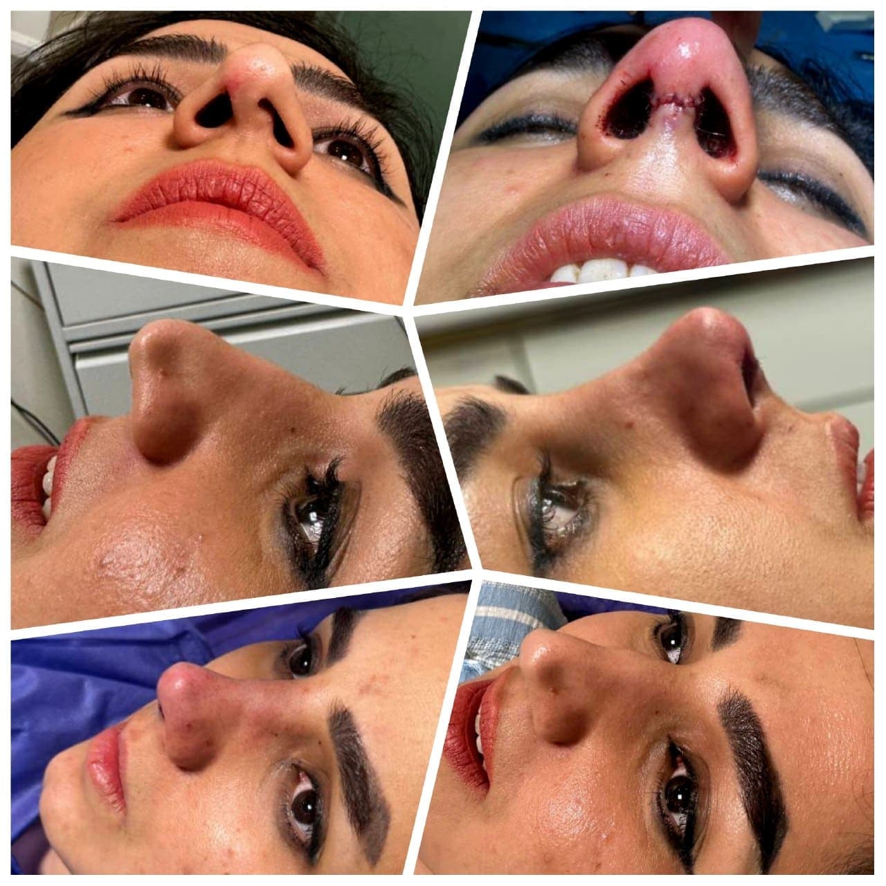 نمونه جراحی بینی و زیبایی صورت توسط دکتر نرگس مطلوبی، مورد ۲۷