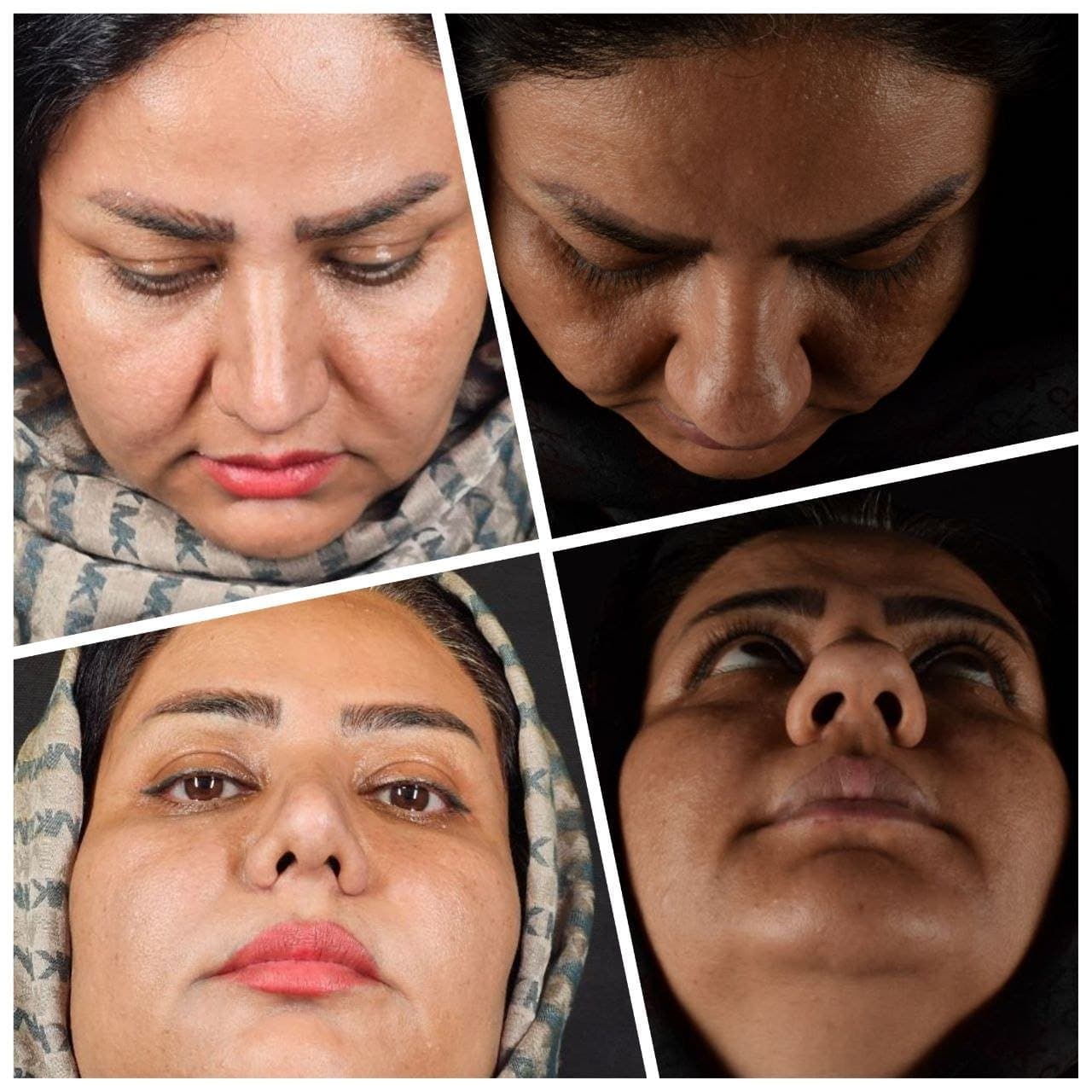 نمونه جراحی بینی و زیبایی صورت توسط دکتر نرگس مطلوبی، مورد ۳۲