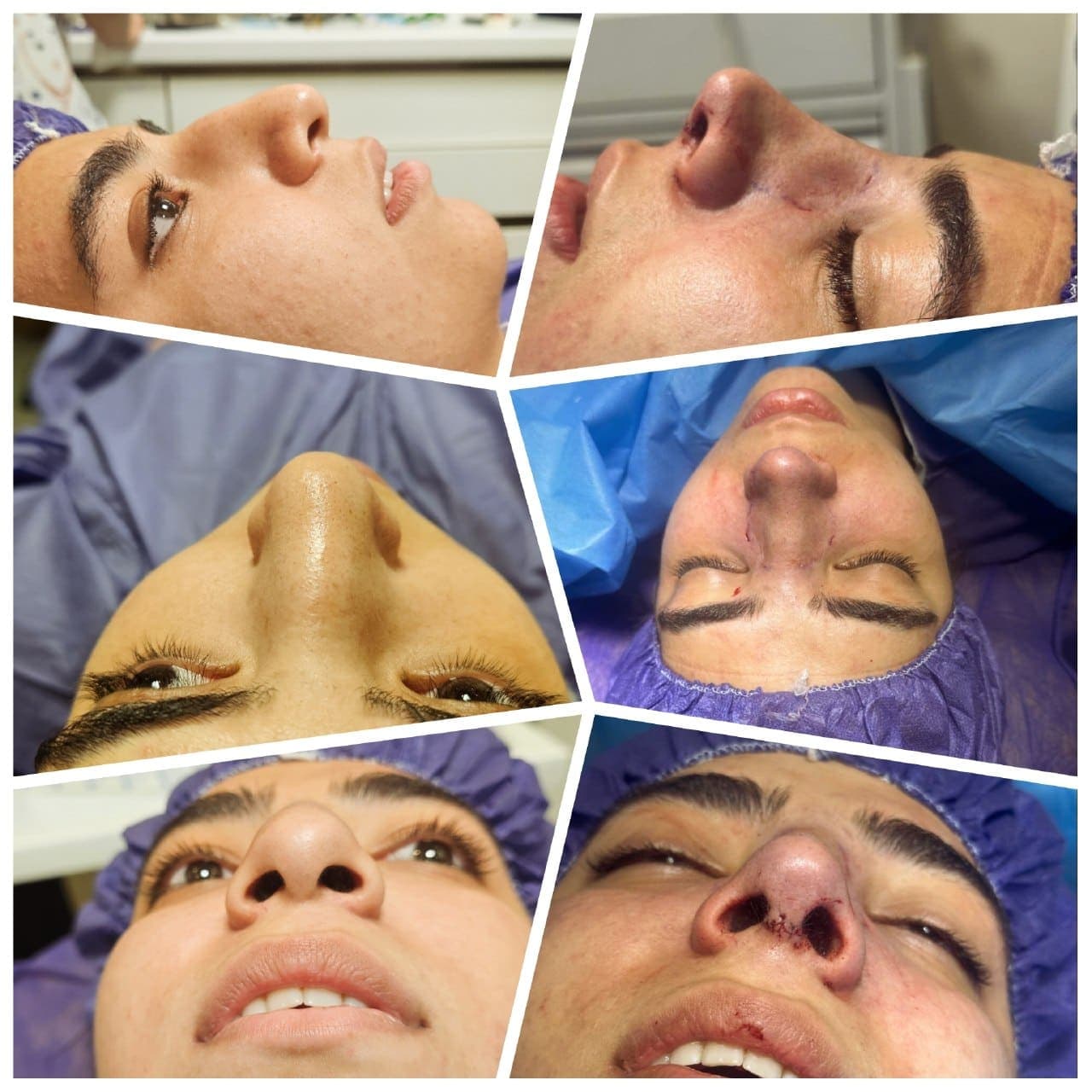 نمونه جراحی بینی و زیبایی صورت توسط دکتر نرگس مطلوبی، مورد ۳۳