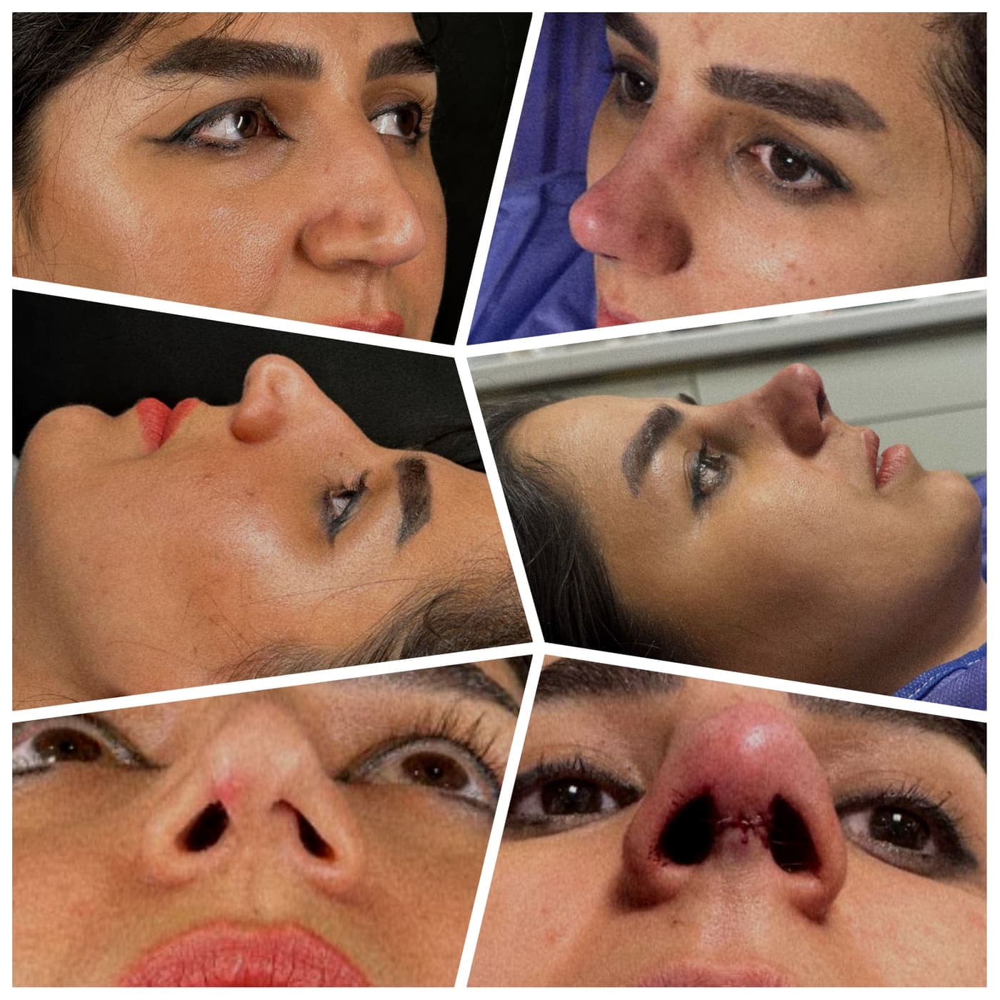 نمونه جراحی بینی و زیبایی صورت توسط دکتر نرگس مطلوبی، مورد ۴۲