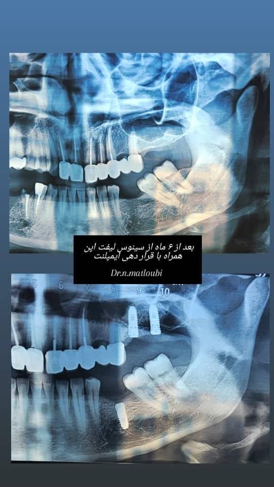 نمونه ایمپلنت و جراحی فک و صورت توسط دکتر نرگس مطلوبی، مورد ۱
