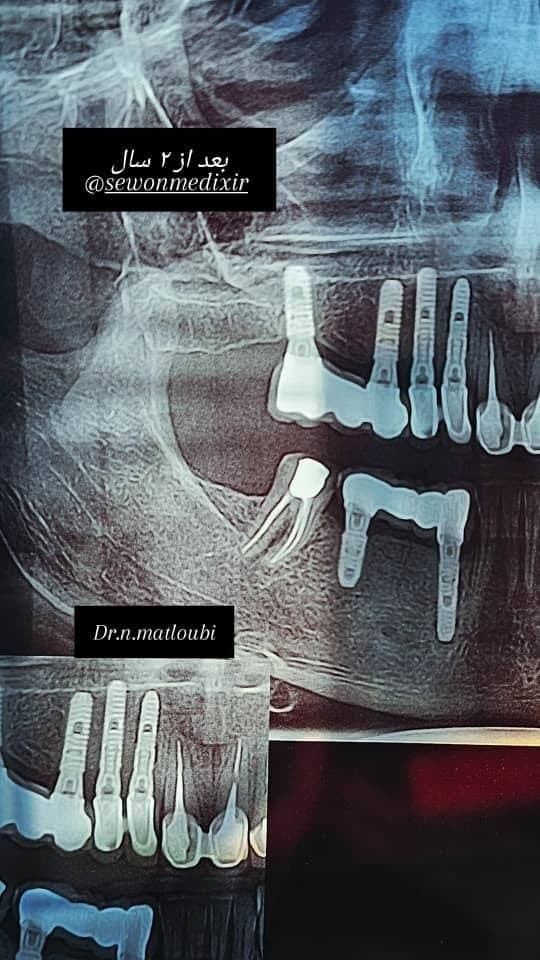 نمونه ایمپلنت و جراحی فک و صورت توسط دکتر نرگس مطلوبی، مورد ۲
