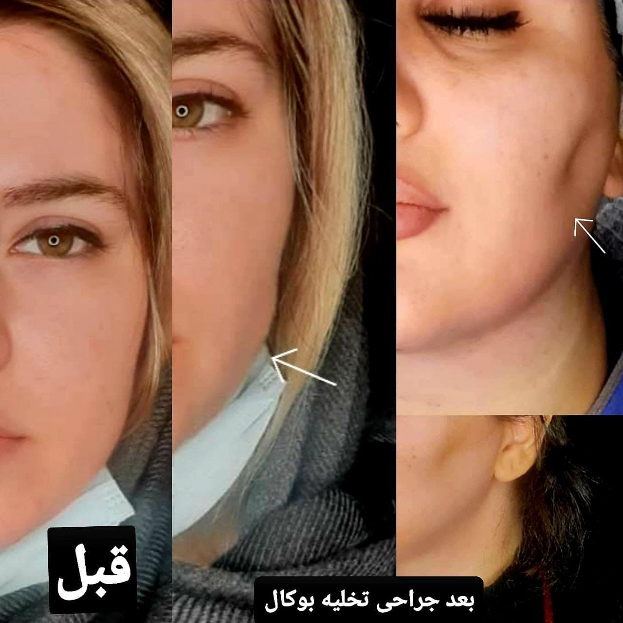 تخلیه چربی بوکال، نمونه قبل و بعد